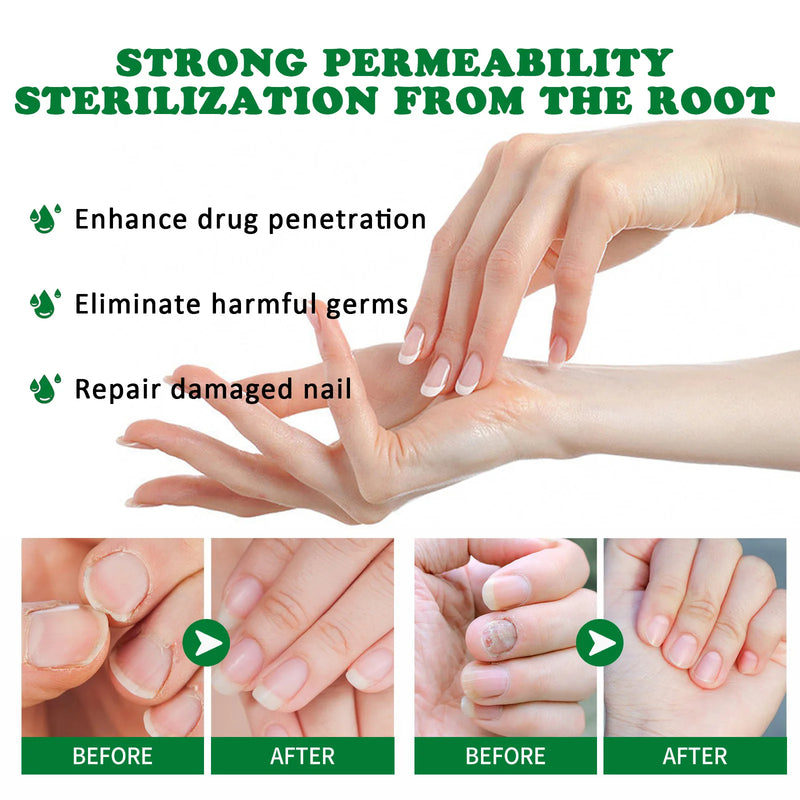 1-5Pcs Nail Fungal Treatment Device 7 Days Repair Oil Foot Toe Essence Anti Infection Paronychia Ginger Onychomycosis Gel Care