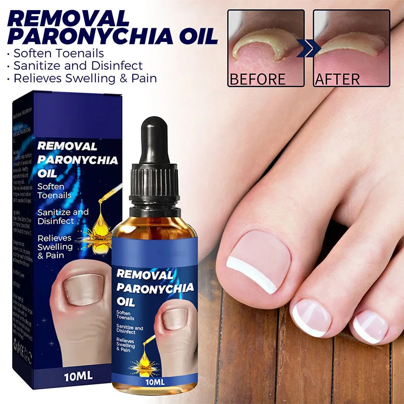 Toenailcare Removal Paronychia Oil Ingrown Toenail Treatment Nail Renewal Liquid Bad Nail Thicken Nail Soft Nail Repair Solution