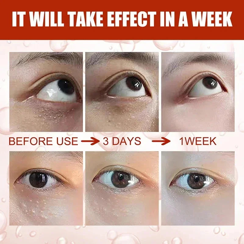 Fat Granules Remover Eye Cream Effective Remove Fat Granules Puffiness Anti-Particles Milia Remover Product Repair Eye Skin Care