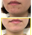 SOME BY MI Bye Bye Mitesser 30 Tage Miracle Green Tea Tox Bubble Cleanser Pickel Akne Behandlung Mitesser Entfernung Peeling